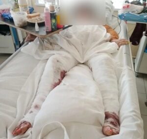 Упавшей в яму с кипятком астраханке выплатят компенсацию